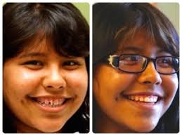 It's possible to use rubber bands in conjunction with braces to move teeth forward or backward so gaps are closed while also correcting underbites or overbites. The Dangers Of Gap Bands An Open Letter To Teens