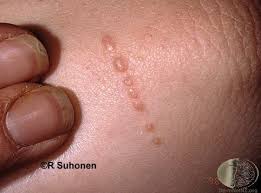 Quizen du ikke visste at du ventet på! Behandling Av Mollusker Mollusker I Underlivet Oslo Hudlegesenter