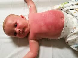 See more ideas about sun allergy, heat rash, allergy rash. Mom Urges Do Not Buy This Harmful Sunscreen After 3 Month Old Is Hospitalized For 3 Days From Burns