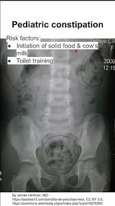 Image result for Pediatric Constipation