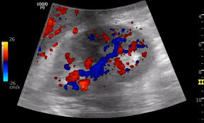 Image result for Renal Infarction