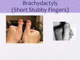 Maybe you would like to learn more about one of these? Trait Survey Widow S Peak Hitch Hiker S Thumb Brachydactyly Short Stubby Fingers Ppt Download