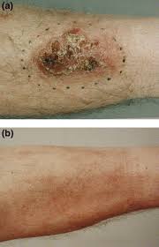 In the united states, it's estimated that doctors diagnose over 100,000 new skin cancer cases each year. Radiation Therapy For Bowen S Disease Of The Skin International Journal Of Radiation Oncology Biology Physics