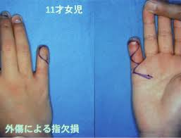 指尖部切断の治療