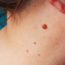 أحمر عشرة ميدان اعراض سرطان الجلد عند النساء بالصور dsvdedommel com