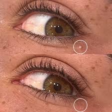 Image result for milium cyst on eyelid