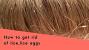 Lice Eggs Nits Vs Dandruff