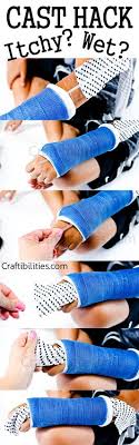 Itchy Cast Wet Cast This Helps Relieve An Itchy Spot Or Help Soak Up Excess Water Or At Least Put Something Between The Arm Cast Broken Bone Kids Broken Arm