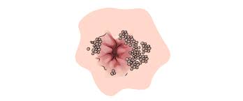 Image result for genital warts