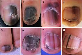 Image result for Acral lentiginous melanoma nail