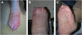 Image result for diabetic toes