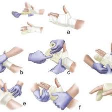 Image result for Radial Gutter Cast