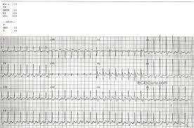 Supraventricular tachycardia (svt) svt is a broad term for a number of tachyarrhythmias that originate above the ventricular electrical conduction system (purkinje fibers). Paroxysmal Supraventricular Tachycardia Ecg Guru Instructor Resources