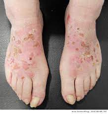 Allergic Contact Dermatitis By Anatomical Regions Diagnostic Clues Actas Dermo Sifiliograficas