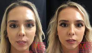 How much juvederm for lips. Juvederm Injections For Lip Augmentation Juvederm Volbella Nyc