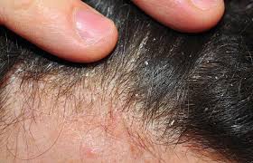 Different Types Of Dandruff And How To Stop Them Dandruff Skin Types Skin Care Steps