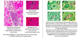 Image result for Polymyositis