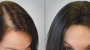 Alopezie bei frauen kann viele gründe haben, unter anderem wie lange hält eine haarverpflanzung? Haartransplantation Fur Frauen Capilclinic