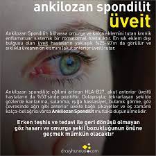 Ankilozan Spondilitte Goz Tutulumu Uveit Ankilozan Spondilit Tip Saglikli Yasam