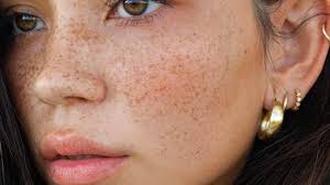 Image result for Freckled skin