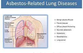 Being exposed to asbestos does increase your risk of developing a serious lung condition such as asbestosis, mesothelioma or lung cancer. Figure 2 From Malignant Pleural Mesothelioma What S New 2012 Update Of The Consensus Statement From The International Mesothelioma Interest Group Semantic Scholar