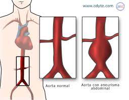 Aneurisma de aorta abdominal, es una dilatación localizada de la aorta abdominal cuando el diámetro es más grande que 3 cm o 50% más grande de lo normal. Tratamiento Endovascular Del Aneurisma Abdominal De Aorta