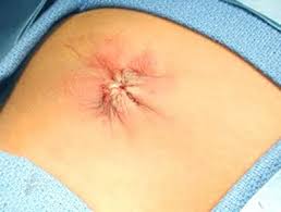 Image result for Umbilicus botryoides