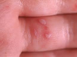 Hand Foot And Mouth Disease In Babies Babycentre Uk