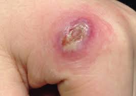 Image result for Nodule