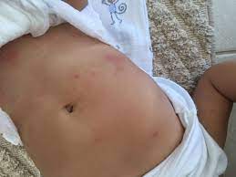 baskent universitesi ankara hastanesi tani ve tedavi birimlerimiz ulseratif kolit crohn hastaligi merkezi