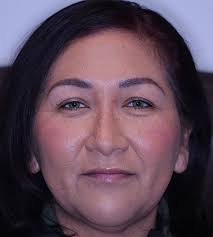 ColorEyes™ Keratopigmentation Los Angeles & Beverly Hills CA