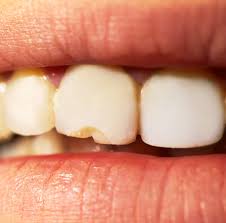 Image result for Tooth Fracture