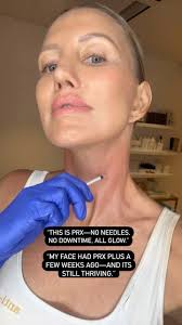 ✨ 8 rounds of PRX later and yes… I still get excited for every treatment!  ✨, Today I treated myself to a neck session 💆‍♀️ (because let’s be honest,  your neck tells