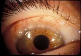 Image result for Vernal Conjunctivitis