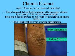 It's a case of recalcitrant eczema. Atopic Dermatitis By Leow Atomic Chuan Tse Group