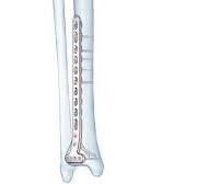 LCP® Anterolateral Distal Tibia Plates (3.5 mm) | DePuy ...