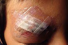 Steristrips keep the wound clean and protected while it heals. Wound Closure Strip Wikipedia