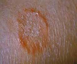 The label states that it does, but it doesn't. How To Remove Ringworm Fungus How To Clean Stuff Net