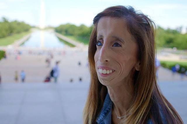 Dealing with disorder, Lizzie Velasquez displays 'A Brave Heart' &ndash; Daily  News