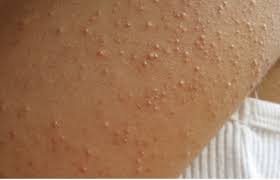 Image result for Keratosis pilaris