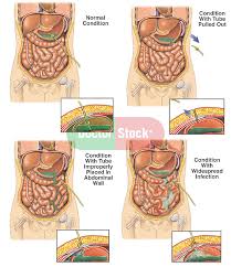Improper Placement Of Gastrostomy Tube With Subsequent Widespread Infection Doctor Stock