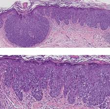 Image result for Merkel Cell Carcinoma