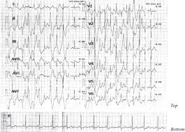 Image result for Exercise Induced Syncope