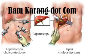7 tanda sakit batu karang: Penyakit Batu Karang Home Facebook