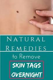 Overnight Remedy To Get Rid Of Skin Tags Skintagremover Skintag Skintagremoval Skintagshomeremedies Di Skin Tag Removal Skin Tags Home Remedies Skin Moles