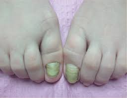 treating dystrophic hallux nails in a