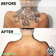 Our team of tattoo removal experts has put together educational resources so you can fully understand the truth about tattoo removal. How Does Laser Tattoo Removal Work Mj Driver Laser Tattoo Removal