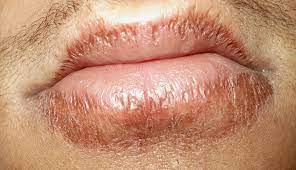 However, you need to be careful about how much ventilation and airflow you offer your cannabis plants. Cheilitis Wikipedia