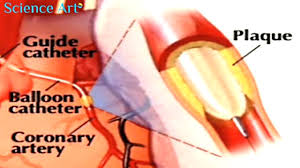 Angioplasty is a keyhole surgery procedure for repairing damaged or diseased blood vessels. Angioplasty Health Navigator Nz