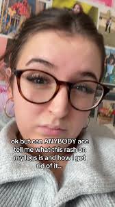 Nurse Jackie Irish Leg Rash